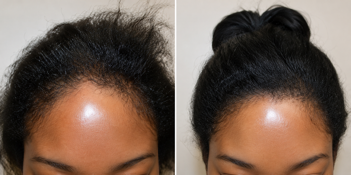 Nicole hair transformation before and after